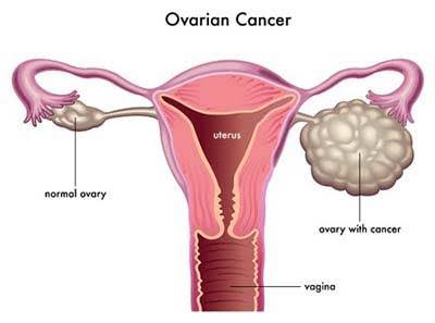 Ovarian Cancer